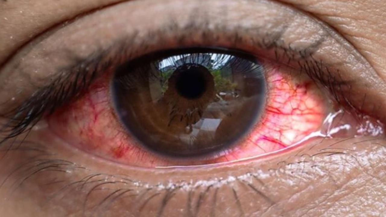 Uganda'da salgın: 7 bin 500 kişide "kırmızı göz" hastalığı görüldü