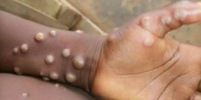 Türkiye Sağlık Bakanlığı’ndan ‘M çiçeği’ açıklaması