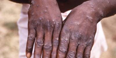 BM: Maymun çiçeği virüsü, 20 yaş altında en çok Afrika ülkesi Burundi'de tespit edildi